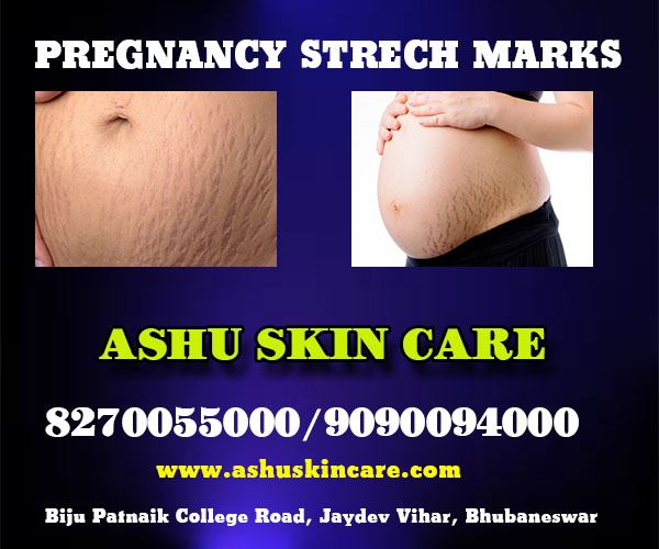 best pregnancy strech mark remove clinic in bhubaneswar near apollo hospital